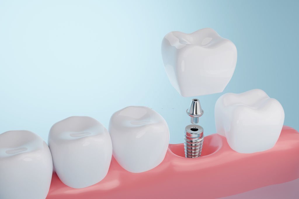 implants-dentaire.jpg