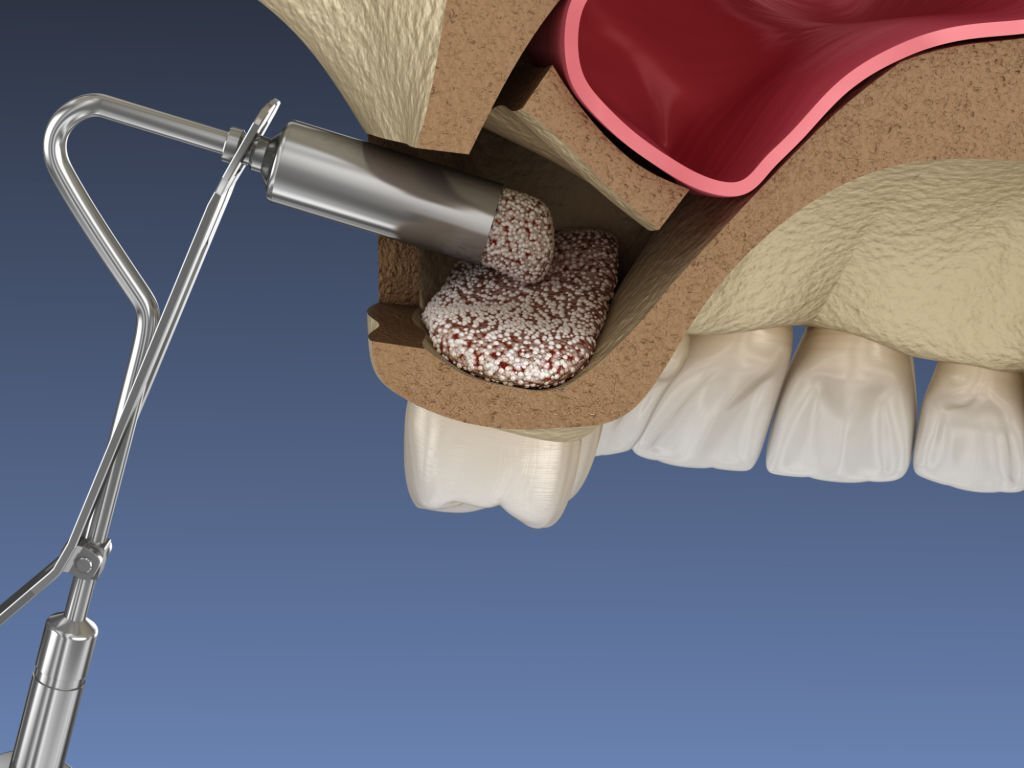 Sinus Lift Surgery - Adding new bone. 3D illustration