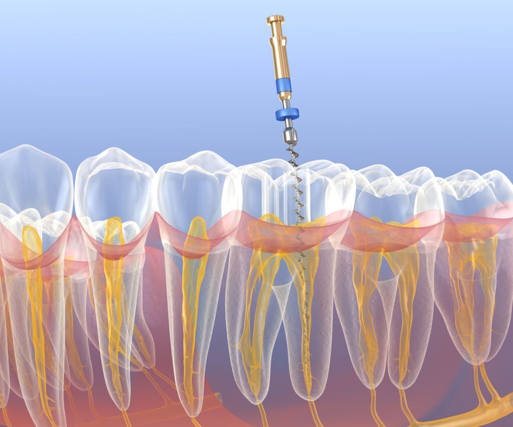 schema-endodontie.jpg